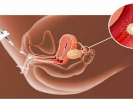 Iui - phương pháp thụ tinh nhân tạo cải thiện khả năng thụ thai